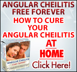 Angular Cheilitis Free For