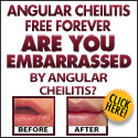 Angular Cheilitis Free For
